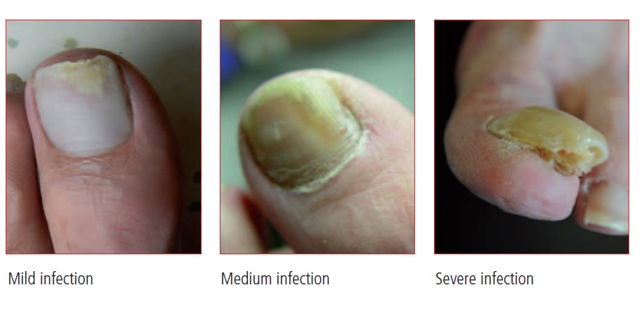 nail psoriasis treatment canada